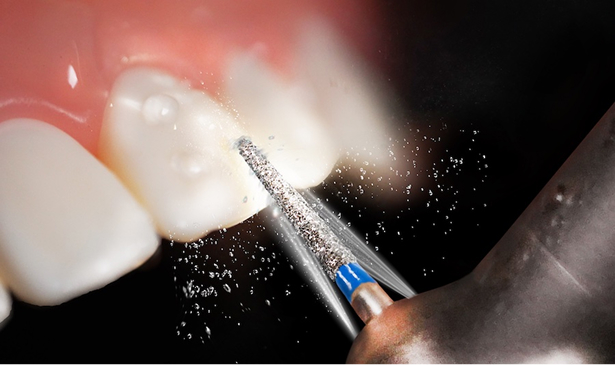 Close-up of dental tool grinding and polishing tooth surface with water spray