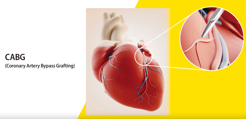 Illustration of CABG (Coronary Artery Bypass Grafting) procedure, showing a heart and a close-up of a surgical needle stitching a blood vessel.