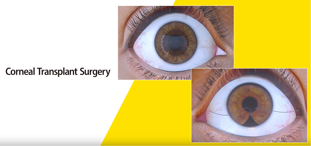 Corneal Transplant Surgery illustration showing two close-up images of an eye during different stages of the procedure.